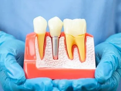 Implantes dentários